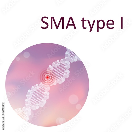 Spinal muscular atrophy type I, illustration photo