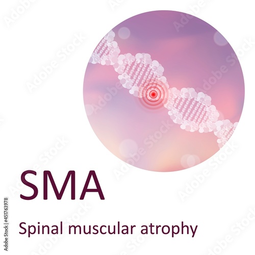 Spinal muscular atrophy, illustration