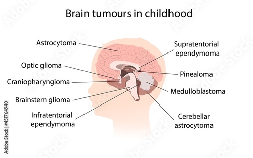 Brain tumour  childhood, illustration
