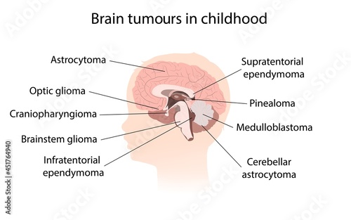 Brain tumour  childhood, illustration photo