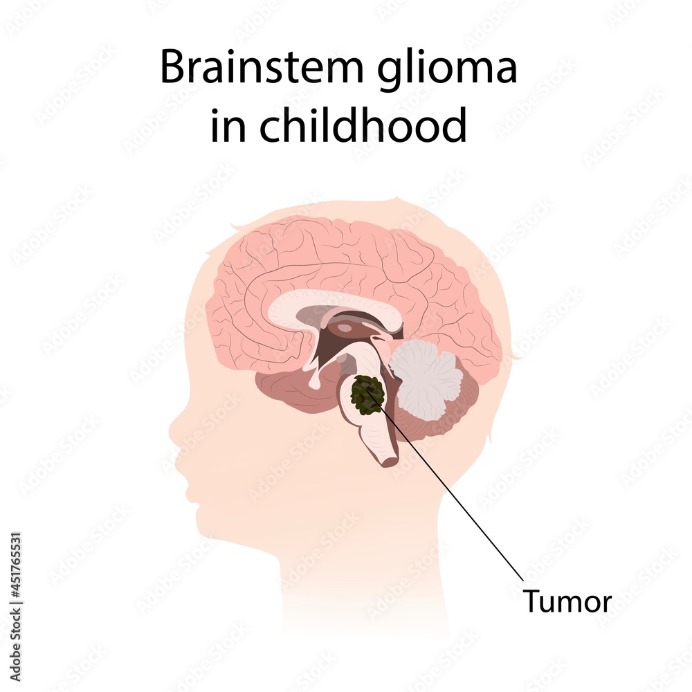 Brainstem glioma in childhood, illustration Stock Illustration | Adobe Stock