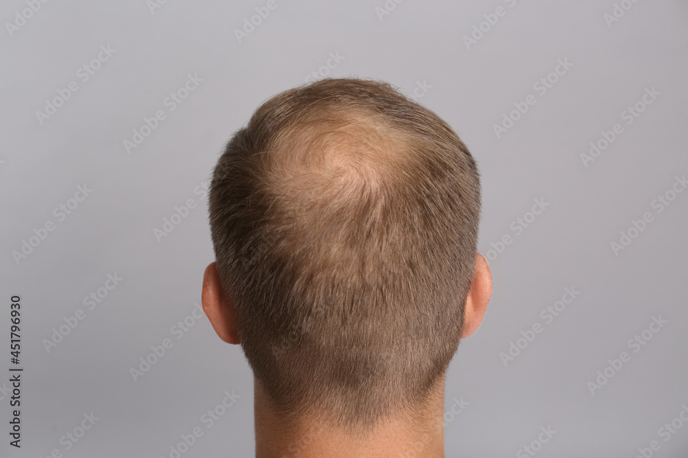 Man with hair loss problem on grey background, back view. Trichology treatment Man with hair loss problem on grey background, back view. Trichology treatment