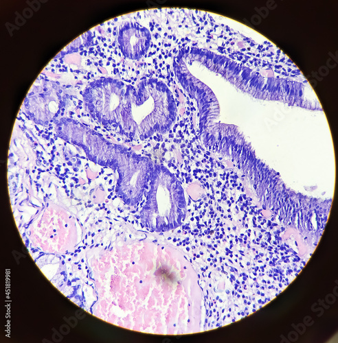 Photomicrograph of a carcinoid tumor, a type of neuroendocrine tumor (NET), which presented as a gastric polyp photo