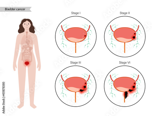 Bladder cancer stages