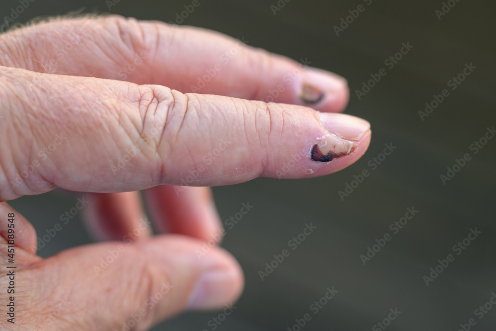 Senior man showing healing soft tissue trauma on his fingers Senior man showing healing soft tissue trauma on his fingers