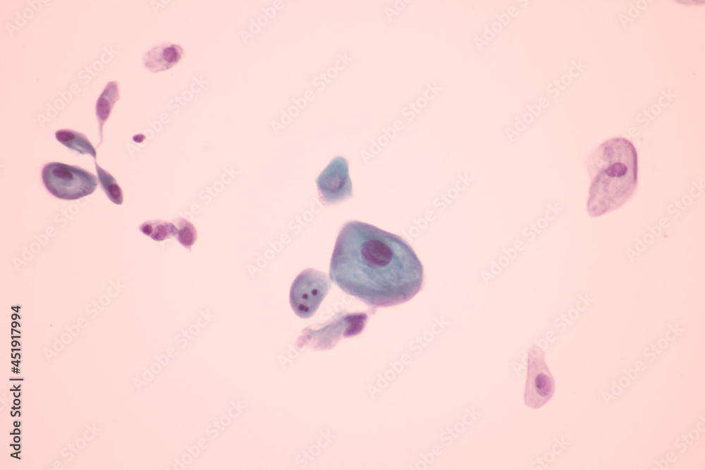 View in microscopic of Abnormal human cervix cells.Squamous epithelium