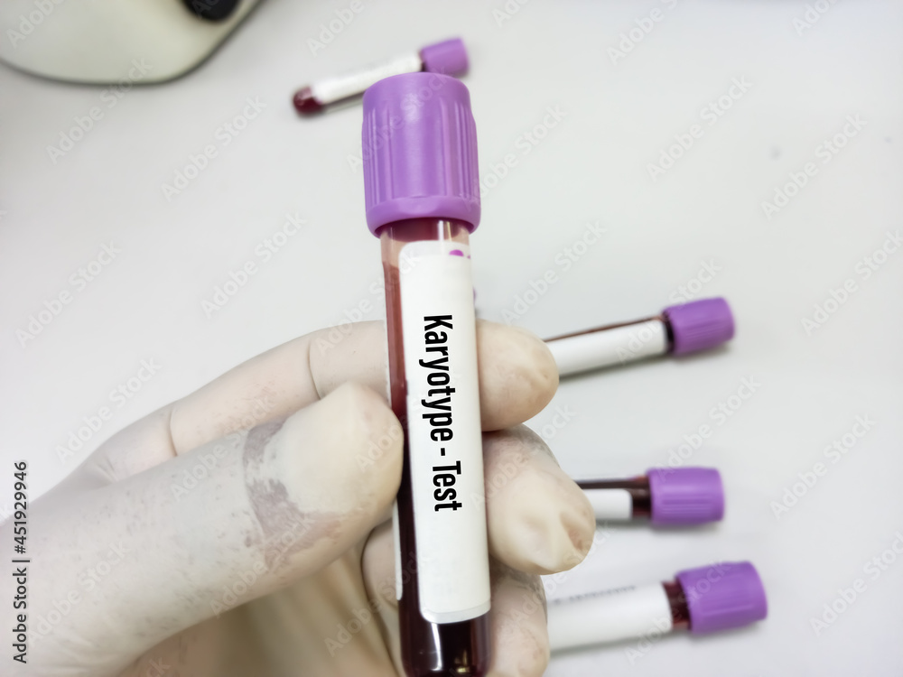 Blood sample for karyotype testing, abnormal chromosome, to identify