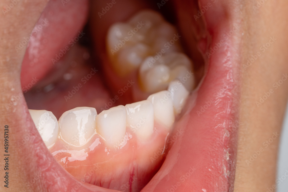 Obraz premium Selective Focus Close Up of a 4 year old kids whose first milk teeth