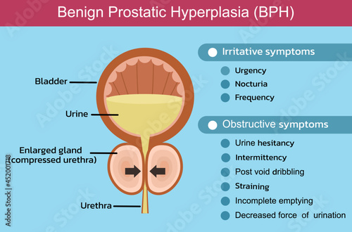 Benign Prostatic Hyperplasia (BPH) photo