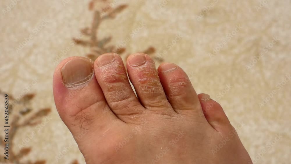 fungus and calluses formed on the toes, a neglected human foot fungus and calluses formed on the toes, a neglected human foot