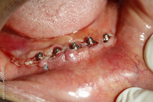 dental implant