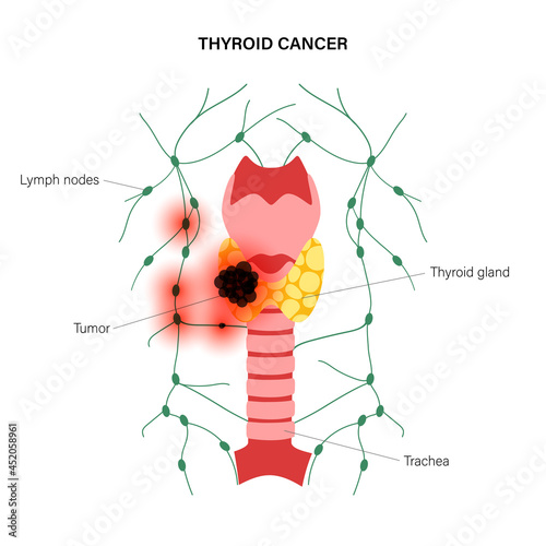 Thyroid cancer stages
