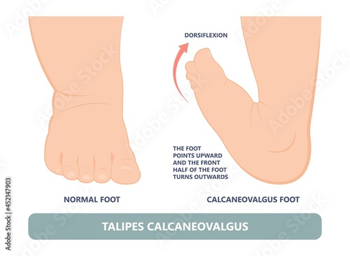 foot deformities infant turned inward upward birth baby tendon leg muscle bone twist feet child limb spina bifida varus valgus talus ankle gene heel Cavus Equinus tibial bow Cleft Lip test toe drop