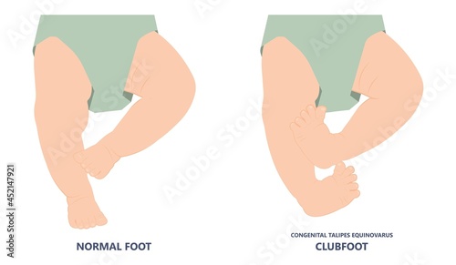 foot deformities infant turned inward upward birth baby tendon leg muscle bone twist feet child limb spina bifida varus valgus talus ankle gene heel Cavus Equinus tibial bow Cleft Lip test toe drop photo