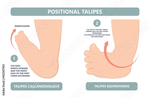 foot deformities infant turned inward upward birth baby tendon leg muscle bone twist feet child limb spina bifida varus valgus talus ankle gene heel Cavus Equinus tibial bow Cleft Lip test toe drop
