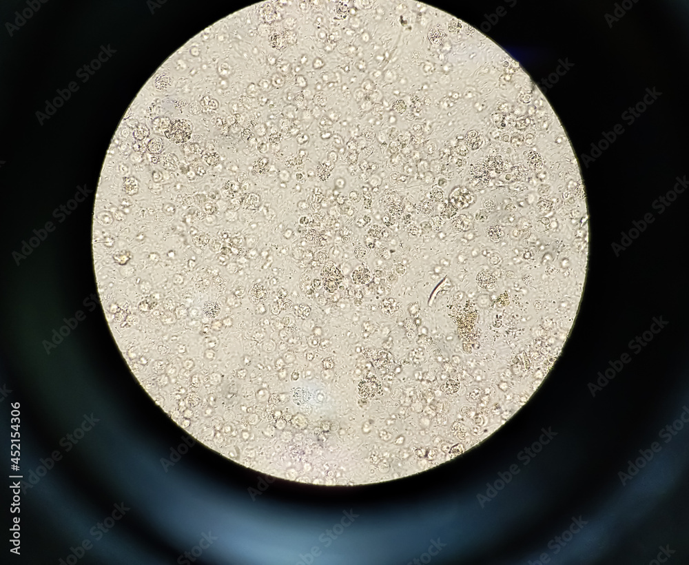 Urine sediment microscopic show plenty of pus cells or white blood cell
