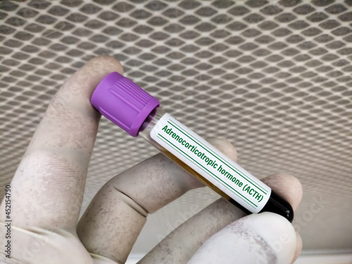 Biochemist holds Blood sample for Adrenocorticotropic hormone (ACTH) test. To diagnosis of Addison's disease photo