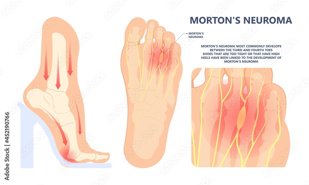Broken Foot Symptoms: What to Expect