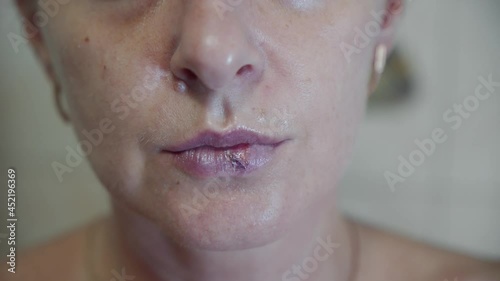 Dermatological disease, herpes, on the lips of a woman. Viral infection, blister. Light touch of the hand to the sore spot. photo
