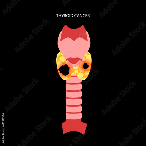 Thyroid cancer stages