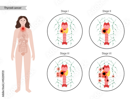 Thyroid cancer stages