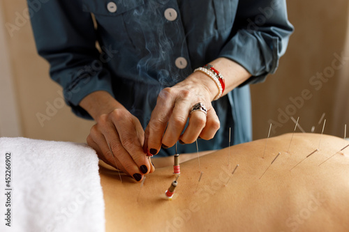 Skilled female practitioner of Chinese medicine using moxibustion healing technique while treating sick patient, heating meridians on nude back using acupuncture needles and mugwort
