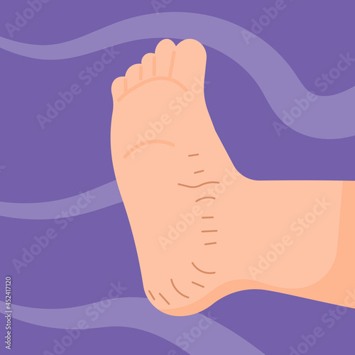 illustration of a cracked sole of the foot at the heel. dry and rough. skin disease. skin health problems. flat cartoon style. vector design