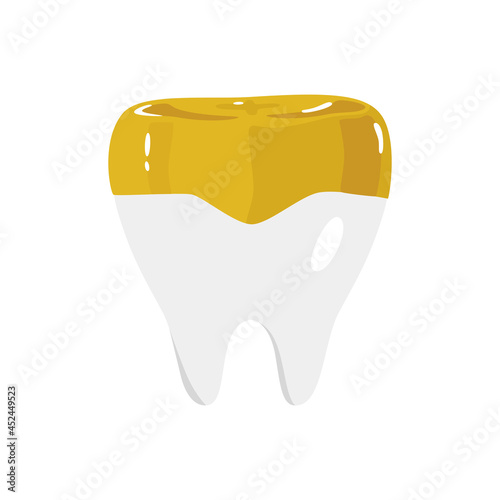 歯のイラスト。部分的に金歯の被せ物をしている歯。
