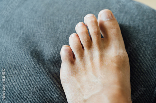 Fotografie Foot little finger injury