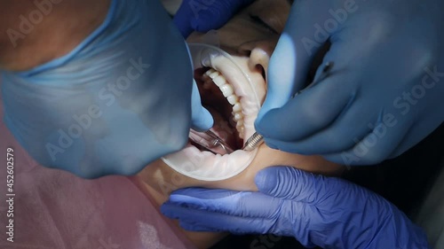 Dentist using surgical pliers to extract a tooth in the dental office. Extracted wisdom tooth covered in blood