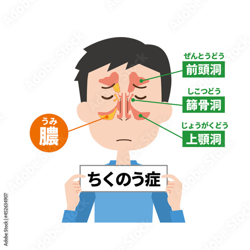 蓄膿症男性の鼻の内部イメージ photo