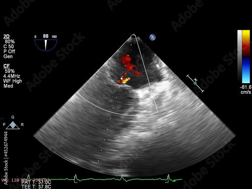 Image of the heart during transesophageal ultrasound with Doppler mode.