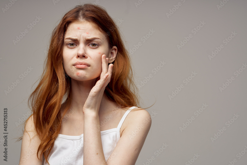 beautiful woman with pimples on the face hygiene light background beautiful woman with pimples on the face hygiene light background