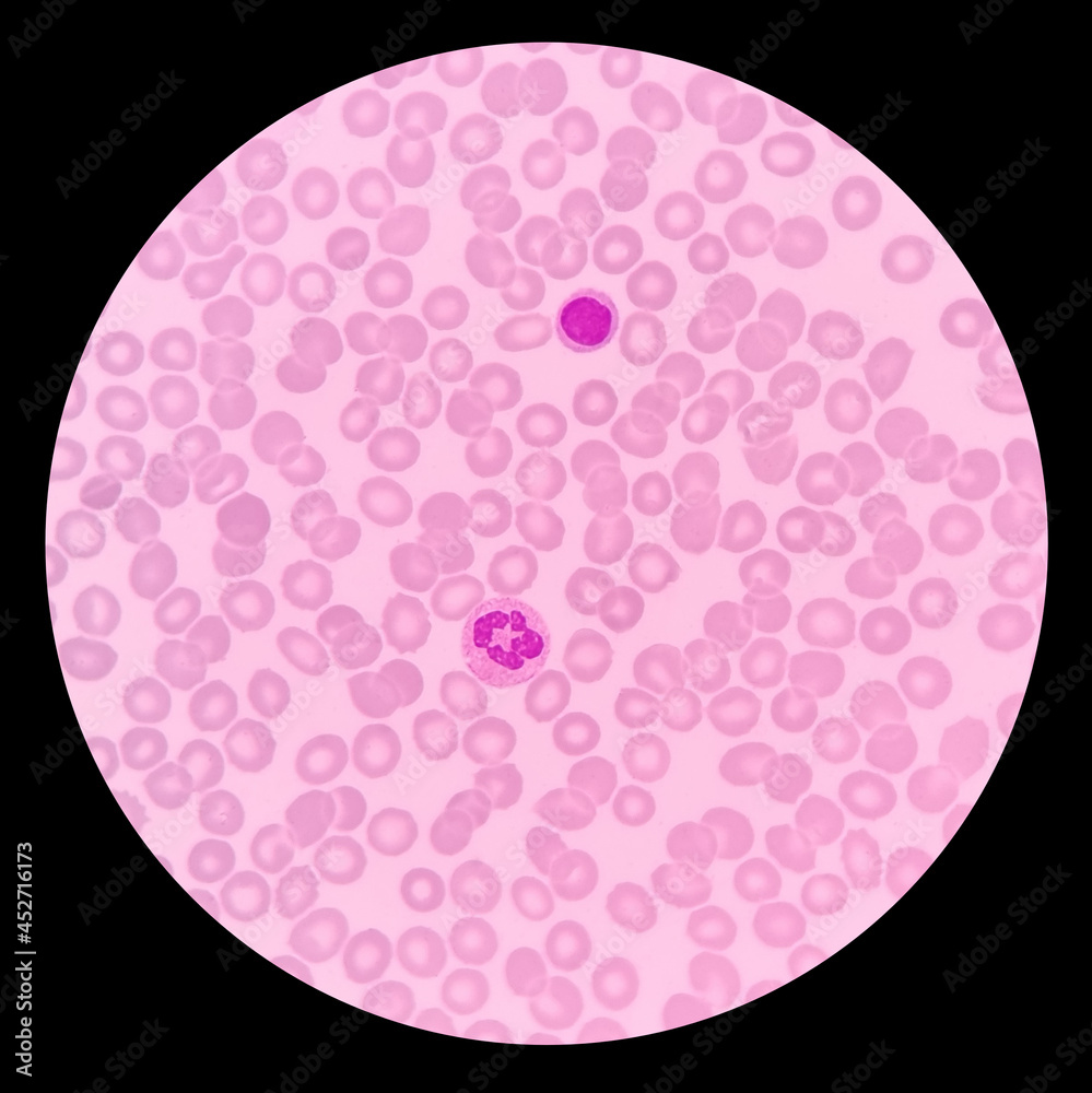 Blood film showing a decrease in platelets. Immune thrombocytopenic purpura (ITP) is a blood disorder characterized by a decrease in the number of platelets in the blood. Blood film showing a decrease in platelets. Immune thrombocytopenic purpura (ITP) is a blood disorder characterized by a decrease in the number of platelets in the blood.