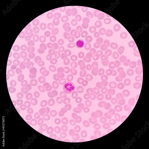 Blood film showing a decrease in platelets. Immune thrombocytopenic purpura (ITP) is a blood disorder characterized by a decrease in the number of platelets in the blood. photo