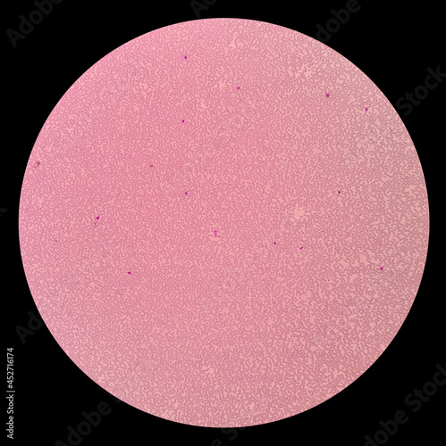 Blood film showing a decrease in platelets. Immune thrombocytopenic purpura (ITP) is a blood disorder characterized by a decrease in the number of platelets in the blood. photo