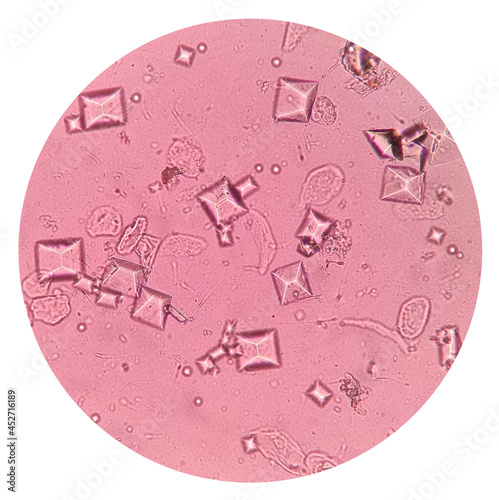 Urine sediment showing Struvite  crystals, spermatozoa, RBC and squamous epithelial cells. Triple phosphate renal calculi are formed as a result of urinary tract infection by urease-forming organisms.