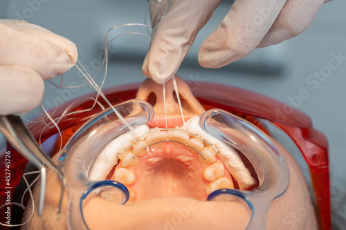 placing the fixed retainer in Process of removing dental braces from a Caucasian girl in a dental clinic with a female dentist