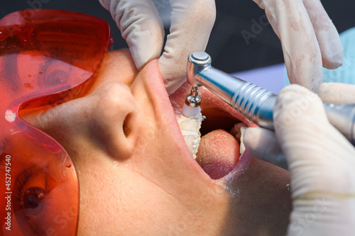 cleaning teeth after Process of removing dental braces from a Caucasian girl in a dental clinic with a female dentist