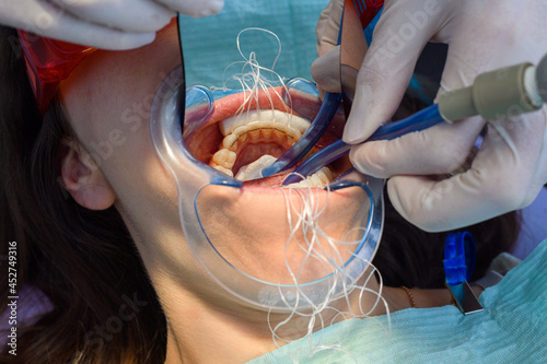 Process of removing dental braces from a Caucasian girl in a dental clinic with a female dentist, placing the fixed retainer