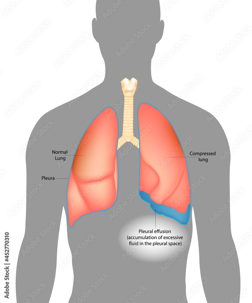 Pleural effusion.Accumulation of excessive fluid in the pleural space