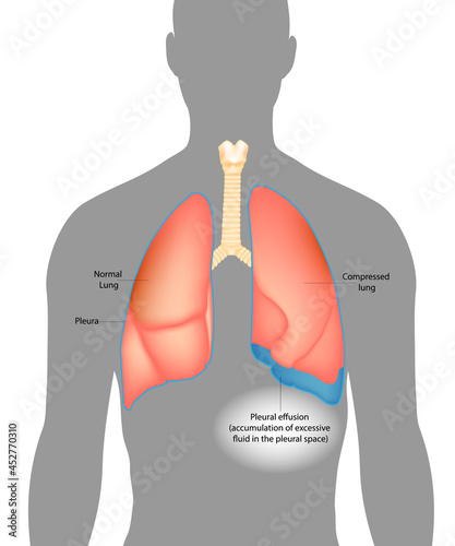 Pleural effusion.Accumulation of excessive fluid in the pleural space. Compressed lung photo