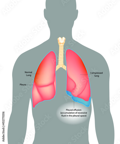 Pleural effusion.Accumulation of excessive fluid in the pleural space. Compressed lung