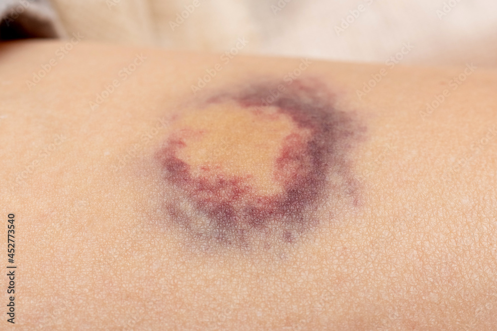Hematoma on a woman's body as a result of violence Hematoma on a woman's body as a result of violence