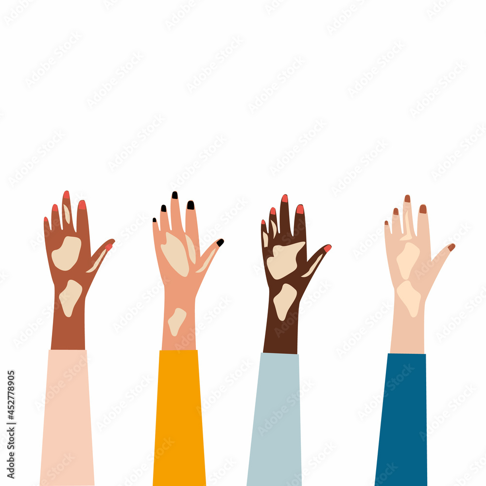 Female hands of different ethnic group with vitiligo skin. Skin hands with vitiligo depigmantation. Vitiligo awareness.Vector illustration Female hands of different ethnic group with vitiligo skin. Skin hands with vitiligo depigmantation. Vitiligo awareness.Vector illustration