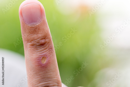 Fotografia Paronychia, swollen finger inflammation due to bacterial infection on a man hand