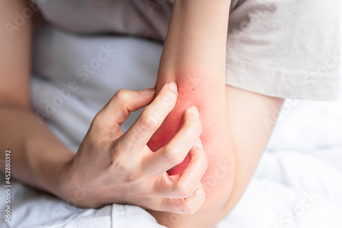 A woman is scratching a red blistered arm due to a foreign body intolerance or an insect bite.