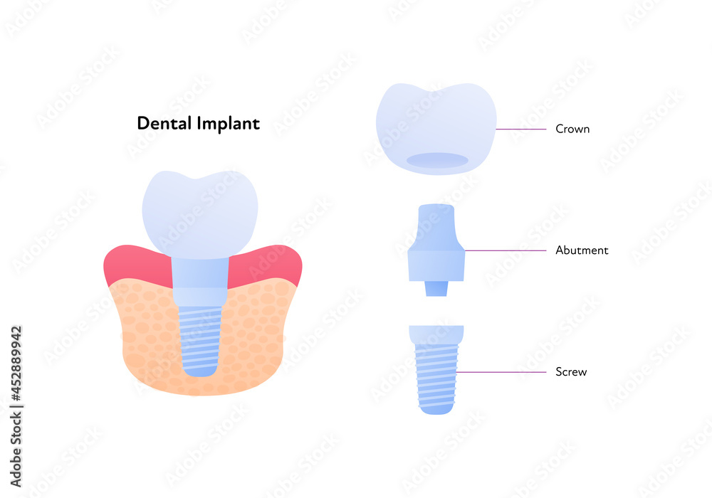 Tooth implant chart. Vector biomedical illustration. Cross section