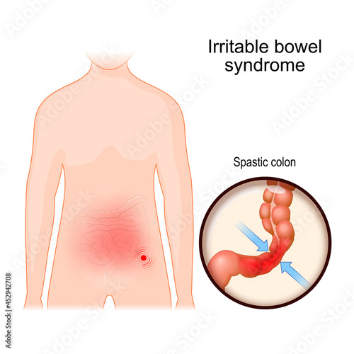Irritable bowel syndrome. IBS