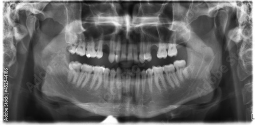 Pantogram szczęki z ubytkami zębów.